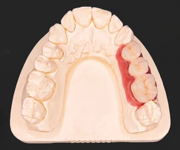 Cement retained implant crowns image2