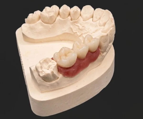 Cement retained implant crowns image4