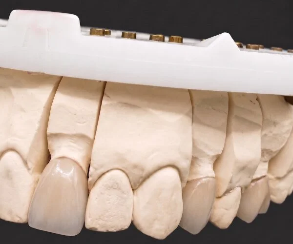 Crowns and bridges layered zirconia image2