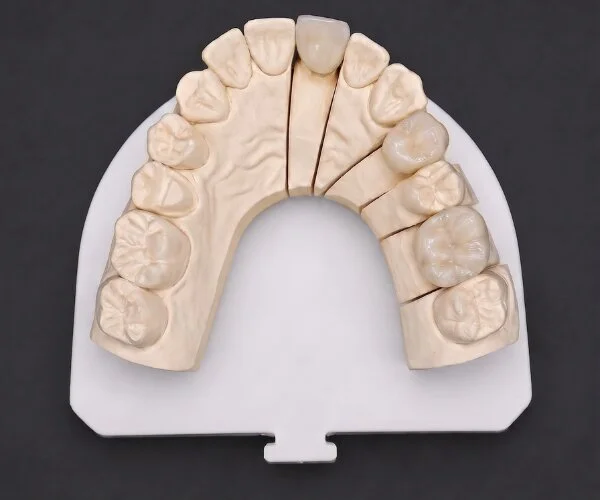 Crowns and bridges layered zirconia image3