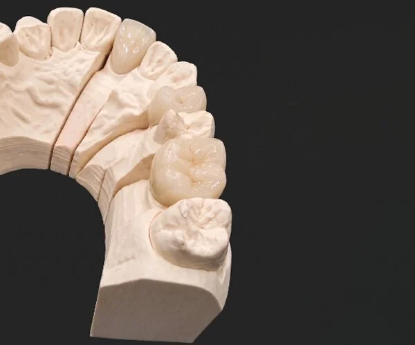Crowns and bridges layered zirconia image4