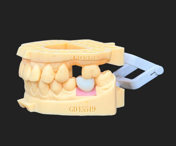 Implant screw retained img3