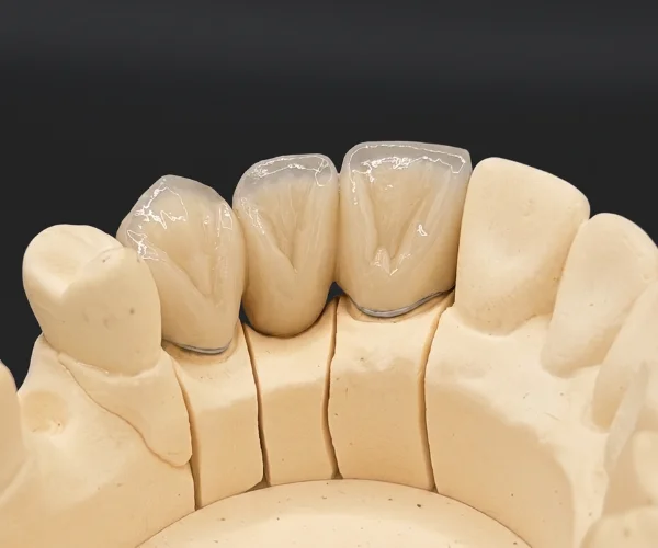 Cosmetics veneers pfm image2