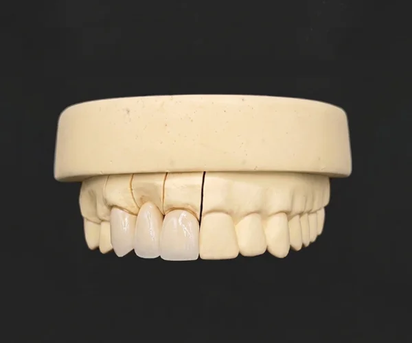 Cosmetics veneers pfm image3